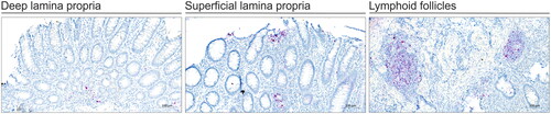 Figure 2. TNF mRNA ISH in IBD colonic tissue. All tissue biopsies were collected before initiation of anti-TNF therapy. ISH for TNF mRNA was done using RNAscope technology and performed on tissue from the three response groups: responders, primary non-responders (PNR) and secondary non-responders (SLOR). The TNF mRNA signal (red stain) is seen in superficial lamina propria (SLP), deep lamina propria (DLP) and lymphoid follicles (LF). Tissue sections were counterstained with haematoxylin. The ISH images are representative for different response groups among adult IBD patient samples.
