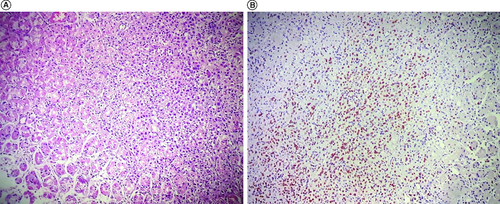 Figure 1. Pathologic findings of gastric biopsies.(A) Tumoral proliferation of independent cells in gastric mucosa (× 200). (B) Immunostaining of tumor cells for estrogen receptors (× 100).