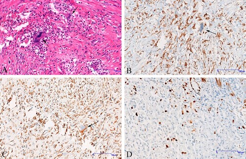 Figure 3. Immunohistochemistry (IHC) findings. (A) The morphology of tumor cells is diverse, and the giant cells of polynuclear tumors are abundant, the cytoplasm is abundant, the nucleus is large, deep staining, and the nucleolus is obvious; Nuclear splitting is easy to see, indicated by the arrows (hematoxylin and eosin, ×200). (B) Neoplastic cells are positive for CD68, nuclear splitting is easy to see, indicated by the arrows (IHC, ×200). (C) Neoplastic cells are positive for Vimentin, nuclear splitting is easy to see, indicated by the arrows (IHC, ×200) (D) Ki67 was examined as a proliferation marker of tumor cells.