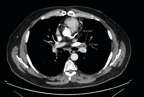 Figure 3. Computed tomography chest from May 2022 showing new proximal thickening of the left upper lobe.