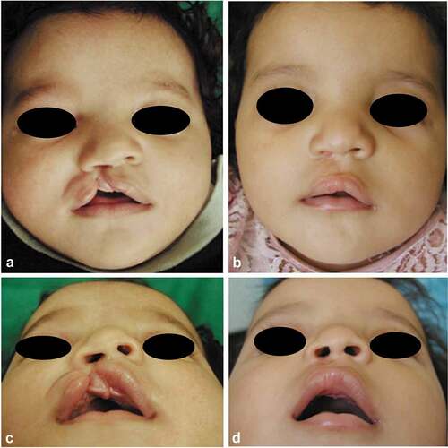 Figure 14. A case of Millard’s group; 3-month-old female, with right-sided unilateral incomplete cleft lip. (a and c) Preoperative frontal and submental views and (b and d) 3 months’ postoperative frontal and submental views