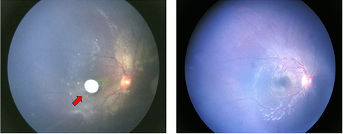 Figure 1 Fundus photographs of a retinoblastoma patient with sphere (type II) vitreous seeding before and after treatment with intravitreal melphalan. Left: Fundus photograph of the patient’s right eye before treatment with intravitreal melphalan showing sphere (type II) vitreous seeding (arrow). Right: Fundus photograph of the patient’s right eye after treatment with intravitreal melphalan showing resolution of vitreous seeding.