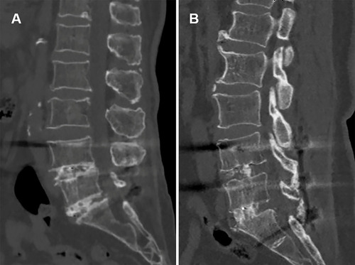 Figure 4 Representative CT images of the TPTD and ZOL groups at 12 months after surgery. (A) CT sagittal image showed solid L4/5 and L5/S1 fusion in the TPTD group. (B) CT sagittal image showed L4/5 and L5/S1 fusion in the ZOL group.