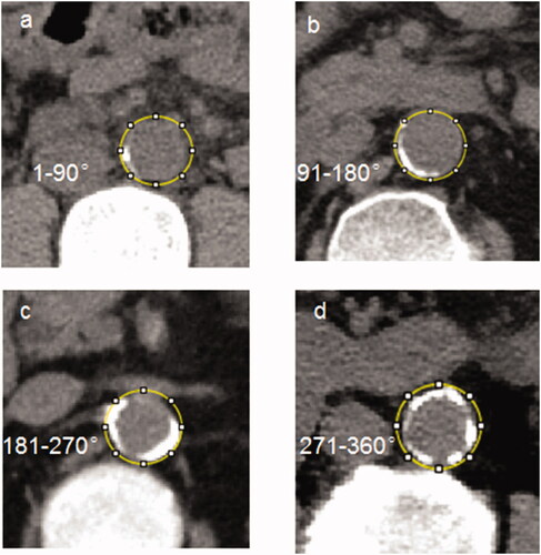 Figure 2. Cross-sectional view of abdominal aortic calcification by CT in four representative cases.