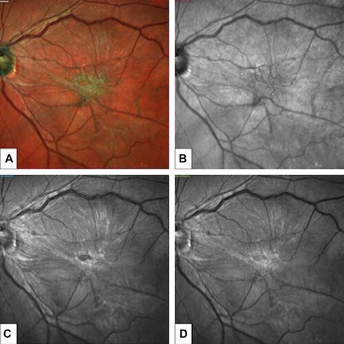 Figure 1 Multicolor imaging of idiopathic epiretinal membrane. Multicolor imaging offers a detailed visualization of the macular area: multicolor montage (A), infrared reflectance (B), blue reflectance (C), green reflectance (D).