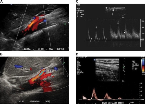 Figure 1 Pulse wave Doppler ultrasound in vascular compression syndrome.