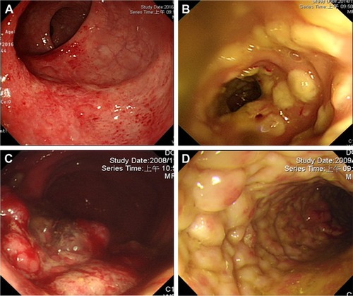 Figure 2 Endoscopic findings of CMV colitis in patients without IBD, except ulcers.