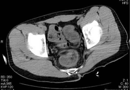 Figure 1 Wall thickening of the sigmoid colon and rectum.