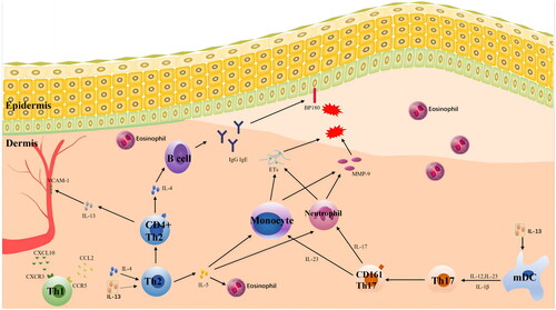 Figure 1. A network of cytokines affects the pathogenesis of BP. The pathogenesis of BP is primarily associated with cytokines related to Th2 and Th17. IL-4, IL-5 and IL-13 cause the recruitment of eosinophils, stimulate the production of antibodies, induce pruritus, promote blister formation and cause other symptoms. IL-17 and IL-23 stimulate the production of matrix metalloproteinase-9 (MMP-9) by related cells, which leads to dermo-epidermal junction (DEJ) separation and the formation of bullae and blisters and can persist in BP inflammation. The serum concentrations of IL-17 and IL-23 are associated with the prognosis of BP.