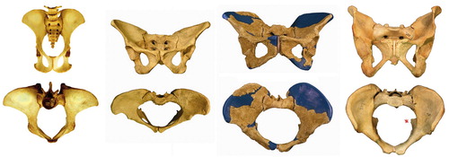 Figure 25. Hominid pelves, from left to right: chimpanzee, Lucy (Australopithecus afarensis, 3.2 my), Homo erectus (1.5 my), Homo sapiens. Note that chimpanzee pelvis has larger AP than ML diameter, then evolves to wider pelvis in Lucy, and from H. erectus pelvis is again increasing in AP diameter by differential growth of the pubic bones. Red asterisk marks ischial spine in Homo pelvis (adapted from Simpson 2008, with permission from AAAS). Scale of chimpanzee pelvis is approximate.