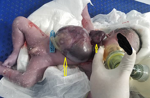 Figure 3 Post-delivery photo shows a baby with omphalocele (large cyst in the abdomen) and heart extruded through the chest (arrows).