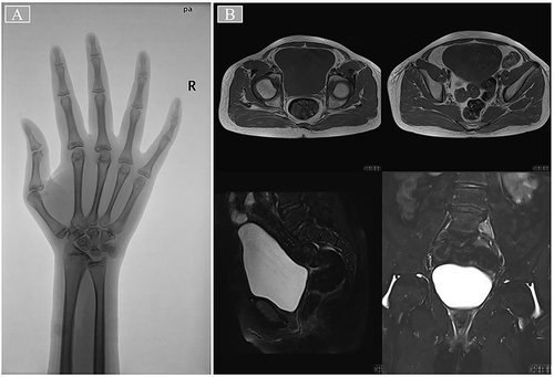 Figure 2 The patient ‘s right wrist bone age film and pelvic magnetic resonance image.