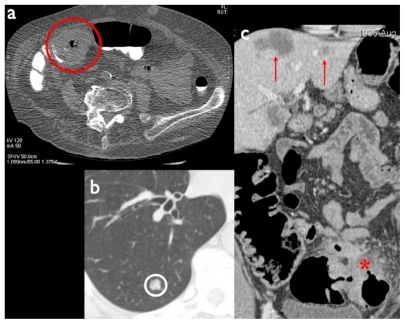 Figure 3 a) Annular stenosing cancer of the right colonic flexure (red circle) using a low dose computed tomography colonography (CTC) protocol. b, c) CTC can be performed with a regular dose protocol for detection of extracolonic disease, such as lung (b: white circle) and liver metastases (c: red arrows) in a patient with locally advanced colorectal cancer (red asterisk).