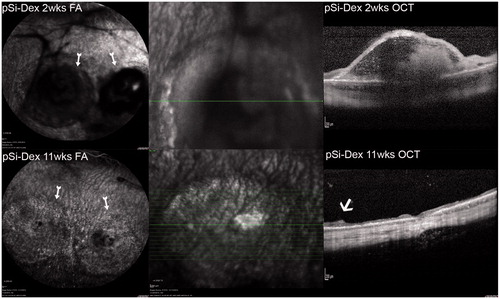 Figure 4. pSiO2-COO-DEX treated eye FA and OCT. FA image in the upper left column, two weeks after the subretinal VEGF/Matrigel injection, shows two round areas of hypofluorescence corresponding to the subretinal injections (arrows). Subretinal Matrigel blocked the fluorescence from the underlying choroid. Vitritis is seen here as black strands in the vitreous, blocking the fluorescence from the choroid underneath. The OCT image in the upper right column demonstrates a dome-shaped retinal bleb with trapped Matrigel within. The lower panel is from the same eye 11 weeks after Matrigel injection or 8 weeks after pSiO2-COO-DEX (pSi-Dex) intravitreal injection. The FA image shows clear vitreous and two round areas of uneven fluorescence corresponding to the atrophic retinal blebs (arrow). The OCT image on the right shows retinal thinning at the bleb area. The arrow points the edge of the atrophic area.