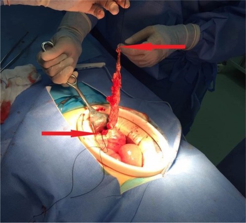 Figure 2 The horseshoe appendix was bundled and cut into two parts (arrow) to manage it side by side for severe adhesions in the appendiceal area.