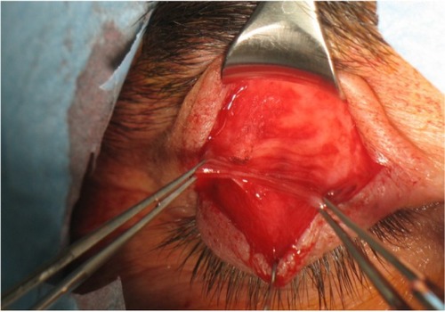 Figure 4 Aponeurosis of the levator muscle.