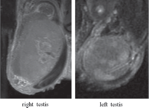 Figure 1. Magnetic resonance imaging (MRI) of enlarged testes showing high signal intensity on Gd-enhanced T1-weighted imaging.