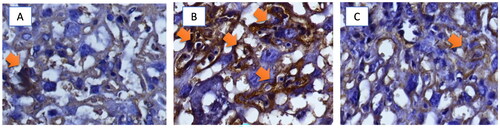 Figure 6. Microscope reading on immunohistochemistry staining of sFlt-1 expression in placenta of the three Groups. (A) Normal pregnancy, (B) SLE without secretome treatment, (C) SLE with secretome treatment. Group B shows significant IHC coloring, representing high expression of sFlt-1. IHC coloring between group A and C shows comparable strength of sFlt-1 expression.