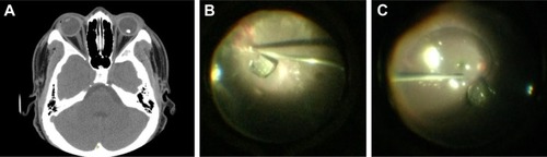 Figure 1 Case 1 with glass IOFB. (A) Axial orbital CT with IOFB in the posterior segment of the left eye. (B) Intraoperative image of glass IOFB near the macula. (C) PFO moving glass IOFB away from macula.