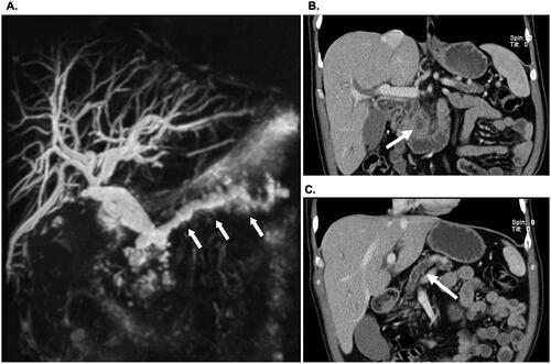 Figure 1. Preoperative diagnosis of main duct IPMN. (A) MRI scan showing a universally dilated main pancreatic duct (arrows) in head, body and tail. (B) CT scan showing a 42 mm mass in the pancreatic head (arrow) and (C) an atrophic pancreatic body and tail with dilated duct (arrow).