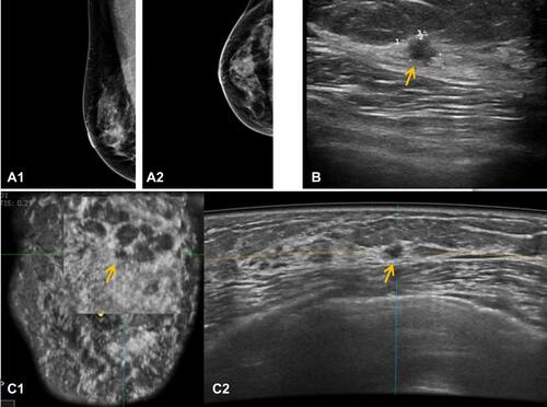 Figure 1 Fifty-one-year-old woman with invasive ductal carcinoma on the right breast. Final pathologic lesion size was 5mm. (A1) Mediolateral and (A2) craniocaudal mammography (MG) was negative. (B) Handheld breast ultrasound imaging (HHUS) showed a subtle irregular, angular, heterogeneous lesion in the upper quadrant, which was assessed as BI-RADS category 4A. Lesion size was measured as 7mm by HHUS. (C2) Automated breast ultrasound image (ABUS) revealed a relatively more prominent irregular, hypoechoic mass in the same location, the coronal-plane ABUS image (C1) well shows the spiculated and angled margin of the mass, which was assessed as BI-RADS category 4B. Lesion size was measured as 6mm by ABUS.