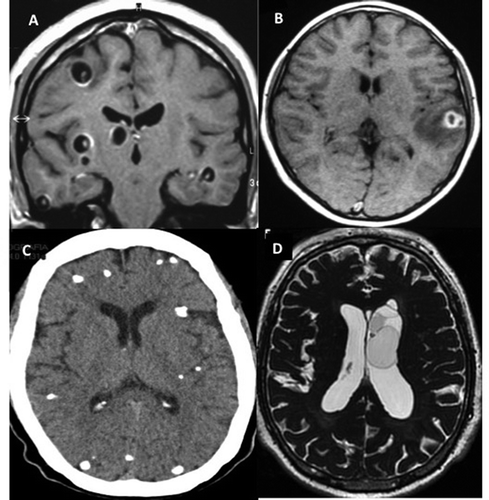Figure 2. Imaging findings in patients with neurocysticercosis. A) MRI of parenchymal vesicular cyst with scolex. B) MRI of colloidal cysticerci with perilesional edema. C) CT scan of many calcified parasites. D) MRI of intraventricular cysts.