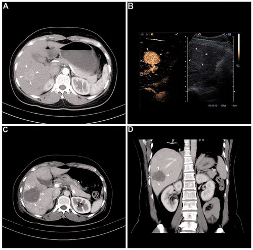 Figure 1. Representative case showing the usefulness of the multiple-electrode switching system radiofrequency ablation (MESS-RFA) in ablating a large volume at one time. (A) Image before MESS-RFA showing. A 3.5-cm nodule (arrowheads) with enhancement in the arterial phase. (B) Intra-procedural contrast-enhanced ultrasound guiding tumor (arrowheads) targeting and monitoring. (C) Axial CT image immediately after MESS-RFA showing that the ablation zone (arrowheads) covers the index tumor (5.5 cm in size). (D) Coronal CT image reconstructed from the immediate post-procedural CT scan shows that the ablation zone (arrowheads) measures 5.4 cm in its coronal long axis.
