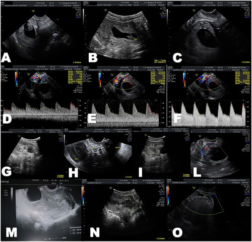 Figure 1. Ultrasound evaluations of each step of scar pregnancy management and follow-up. (A) Transvaginal US which demonstrated a gestational sac close to the previous cesarean section scars; (B) a single embryo corresponding to gestational age; (C) a 2 mm residual myometrium. (D–F) Color-Doppler examination which detected a enhanced myometrial vascularity with different PSV mensuration. (G,H) Transabdominal and transvaginal views of intrauterine and vaginal double baloon; (I) Transabdominal US which demonstrated the compacted pregnancy after intrauterine baloon filling. (L) Doppler examination which highlighted an immediate reduction of vascularization after double baloon placement. (M) The 16 Gy foley baloon posed intrauterine after hysterosuction to preventive reduce the risk of bleeding. (N,O) Ultrasound follow-up one week later with a persistent dishomogeneous and not vascularized intrauterine material of 2.6 cm and the absence of the previous hypervascularization of the myometrium.