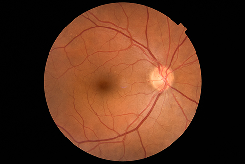 Figure 4 Funduscopic image of healthy optic disc in 61-year female (right eye).