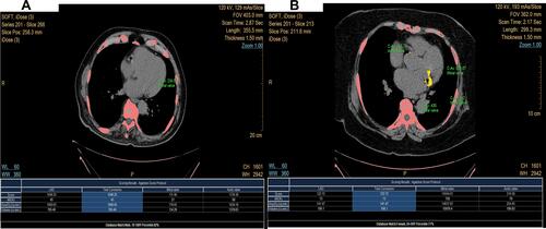 Figure 3 Mitral annulus calcium scoring. (A) Low calcium score. (B) High Calcium Score.