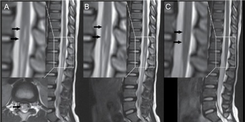 Figure 3 Repeat MRI after the administration of neurotropin.
