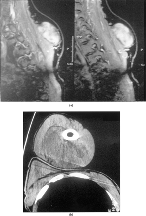 Figure 1 (a) MRI showing the 13 × 10 × 6-cm biceps muscle mass. (b) MRI of the 7 × 6 × 3-cm trapezius muscle mass. Rotation of 90 °.