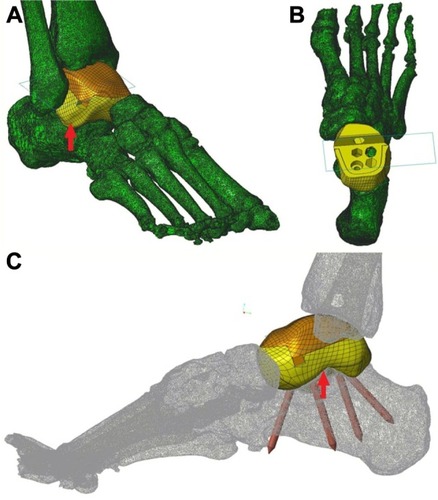 Figure 2 The prosthesis design.