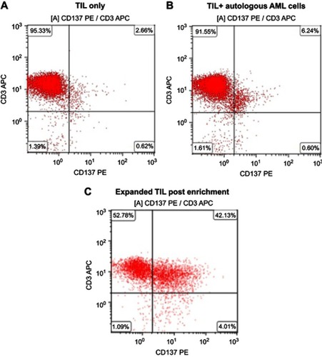 Figure 5 CD137 separation with magnetic beads enriches TIL from AML Patient 3. (A) TIL. (B) Overnight co-culture of TIL and autologous AML cells. (C) Expanded TIL post-CD137-selection.Abbreviations: AML, acute myeloid leukemia; TIL, tumor-infiltrating lymphocytes.