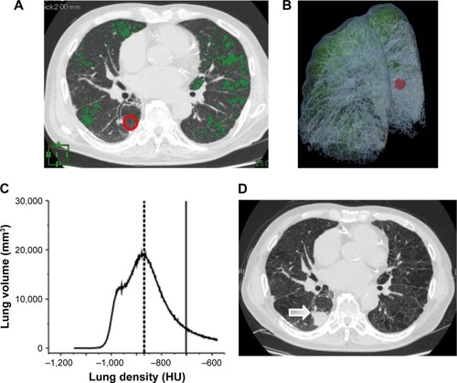 Figure 6 Chest CT scans before and after the appearance of a malignant lesion and the histogram of lung density distribution in a patient who had emphysema and interstitial abnormalities.