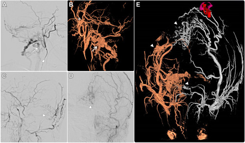 Figure 3 (A) Lateral cerebral angiogram selectively through the left external carotid artery (arrowhead) showed Torcula dAVF (asterisk) and posterior condylar vein (arrow). (B and C) Cerebral angiogram lateral view and 3D reconstruction of the right external carotid artery injection respectively showed posterior condylar vein (arrow), lateral sinus dAVF (asterisk) and the left external carotid artery (arrowhead). (D) AP view cerebral angiogram through the left external carotid artery showed Torcula dAVF (arrowhead). (E) Three dimensional both ECA angiogram (fused image) visualizes Torcula dAVF, and lateral sinus dAVF (arrowheads).