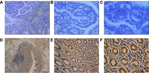 Figure 5 Expression of SIK1 protein in colorectal cancer tissue and adjacent normal tissue by IHC. (A) Weak SIK1 staining in tumor tissue (40x). (B) Weak SIK1 staining in tumor tissue (100x). (C) Weak SIK1 staining in tumor tissue (200x). (D) Strong SIK1 staining in adjacent non-tumor tissue (40x). (E) Strong SIK1 staining in adjacent non-tumor tissue (100x). (F) Strong SIK1 staining in adjacent non-tumor tissue (200x).