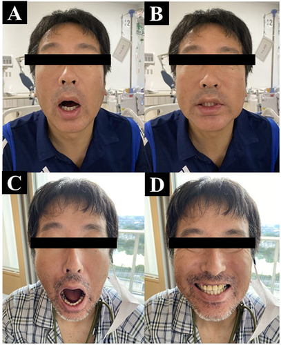 Figure 2 Patient’s characteristics. The patient could not open his mouth (A), trismus, and spasmodic laughter at the time of admission (B), mouth opening after treatment when muscle spasms disappeared (C and D).