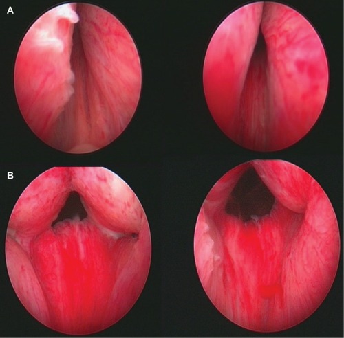 Figure 3 Images of male prostatic urethra before (A) and immediately after (B) insertion of UroLift implants.