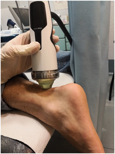 Figure 1. ESWT performed to the Achilles tendon.