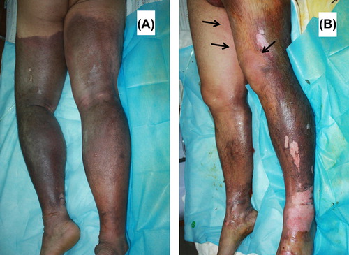 Fig. 1. Chemical burns of lower limbs due to exposing to a mixture of sulphuric acid and hydrofluoric acid. (A) shows the wound surfaces appearing brown with blisters on the admission. (B) shows the changes of wound appearance about 1.5 h post burn. The black arrows indicate the erythma on the surrounded normal skin (colour version of this figure can be found in the online version at www.informahealthcare.com/ctx).