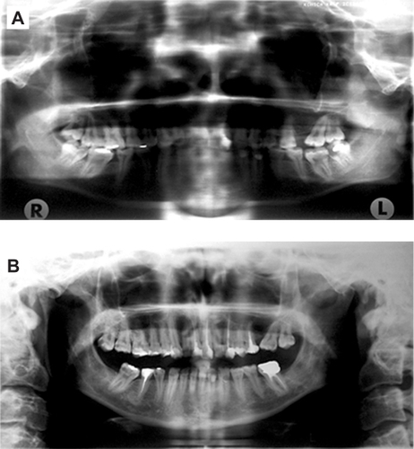 Figure 7 Panoramic radiographs immediately after chemoradiotherapy (A), and six years later (B).