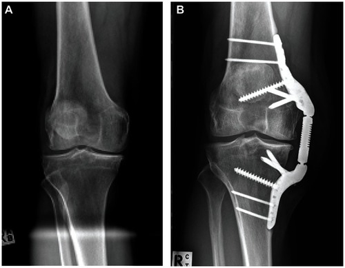 Figure 5 (A) Preoperative anteroposterior radiograph showing pronounced osteoarthritis of the medial compartment. (B) The KineSpring® Knee Implant System (Moximed, Inc, Hayward, CA, USA) at 2 years post-implant.