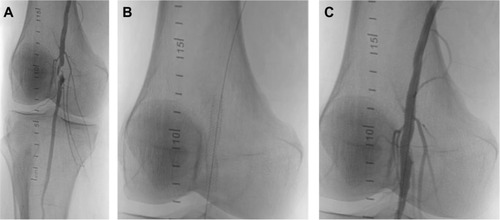 Figure 1 Focal chronic occlusion in an above-knee segment of the popliteal artery (A) treated with a 5.5×40 mm Supera stent (B) without significant residual stenosis (C).
