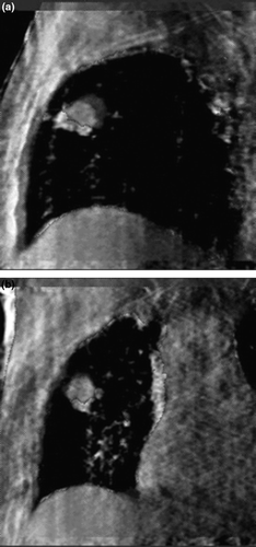 Figure 4.  Respiration correlated CBCT images at maximum inspiration and maximum expiration for patient in Figures 1 and 3 in (a) sagittal and (b) coronal orientations.