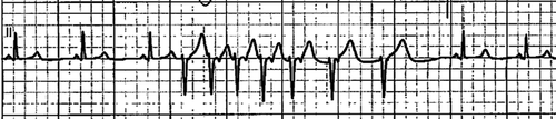 Figure 1. ECHO from the first presentation showing normal cardiac function with no wall motion abnormalities