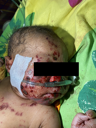Figure 4 Photograph taken in the emergency department of a newborn miraculously surviving being buried alive, showing scattered abrasions and bruises. The image was captured after meticulous cleaning to remove soil from the skin, with the infant under a radiant warmer and receiving oxygen supplementation via nasal prongs.