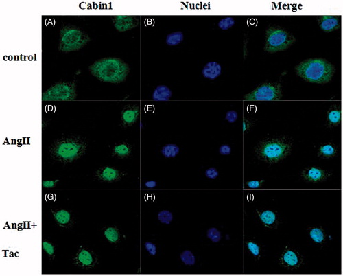Figure 4. The localization of Cabin1 in AngII injuried podocytes. Notes: Fluorescence microscope ×400). (A and C) In normal podocytes, Cabin1 presented strong staining in cytoplasm yet weak staining in the nuclei; (B, E and H) Immunofluorescence staining of nuclei; (D and F) AngII-induced strong staining of Cabin1 in podocytes nuclei; (G and I) Tacrolimus mildly inhibited the strong staining of Cabin1 in the nuclei.