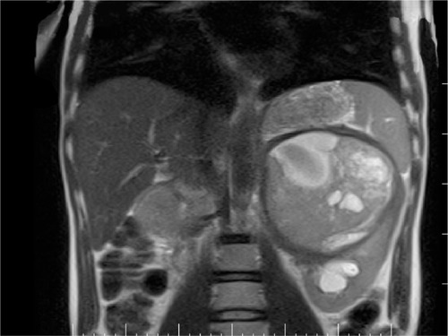 Figure 2 Contrast abdominal magnetic resonance imaging. Nonhomogeneous mass tumor originated from the left adrenal gland.