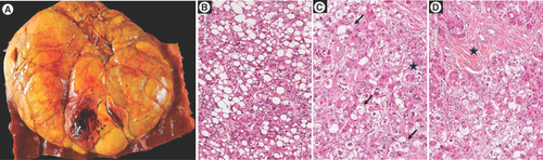 Figure 3. Steatohepatitic variant of hepatocellular carcinoma: main morphological features.(A) Macroscopic view showing a large, well-limited, unencpasulated yellowish tumor nodule with few hemorragic areas; H&E staining showing (B) steatosis with large droplets with tumoral hepatocytes, (C) presence of ballooned tumoral hepatocytes (arrow) and Mallory-Denk bodies within ballooned cells (black star) and (D) fibrous stoma (black star).H&E: Hematoxylin and eosin.